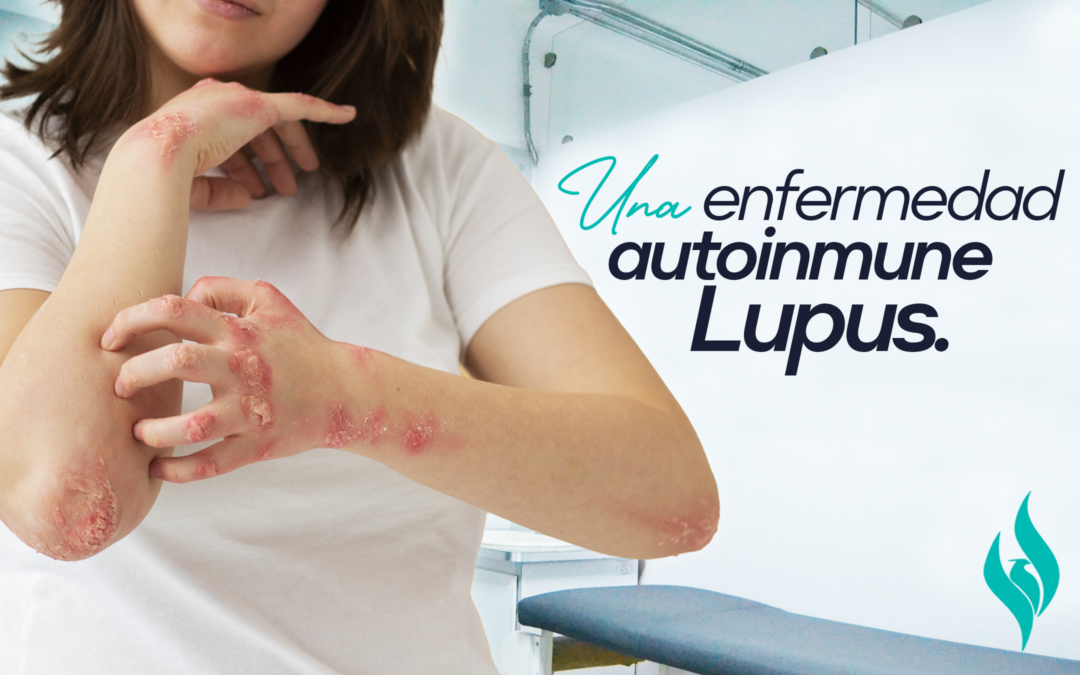 Lupus: una enfermedad autoinmune