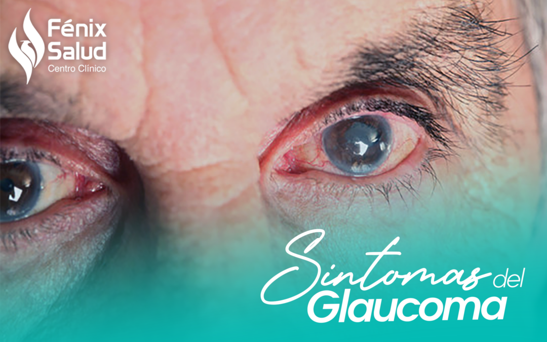 ¿Cómo identificar los síntomas del glaucoma?