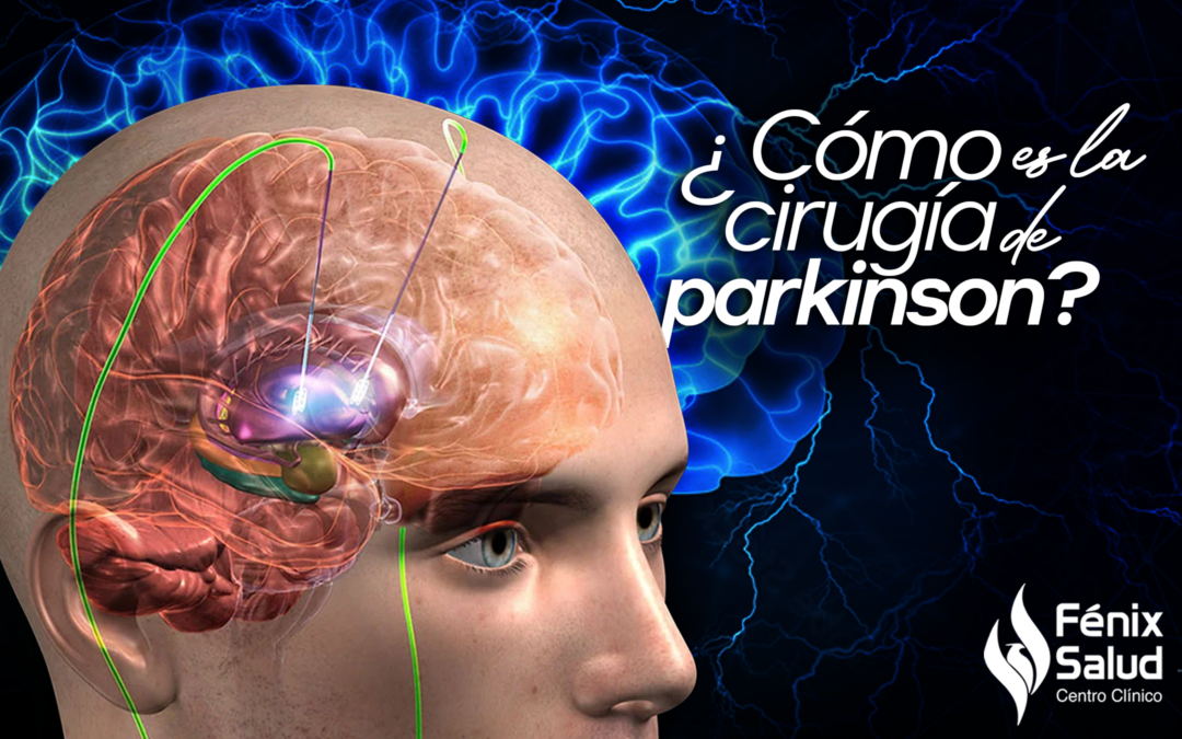Cirugía para Parkinson, ¿qué es el Parkinson?, James Parkinson, Enfermedad de Parkinson, Síntomas del Parkinson, Día Mundial del Parkinson, Tratamiento para el Parkinson, cirugía para pacientes con Parkinson, 11 de abril Día Mundial del Parkinson